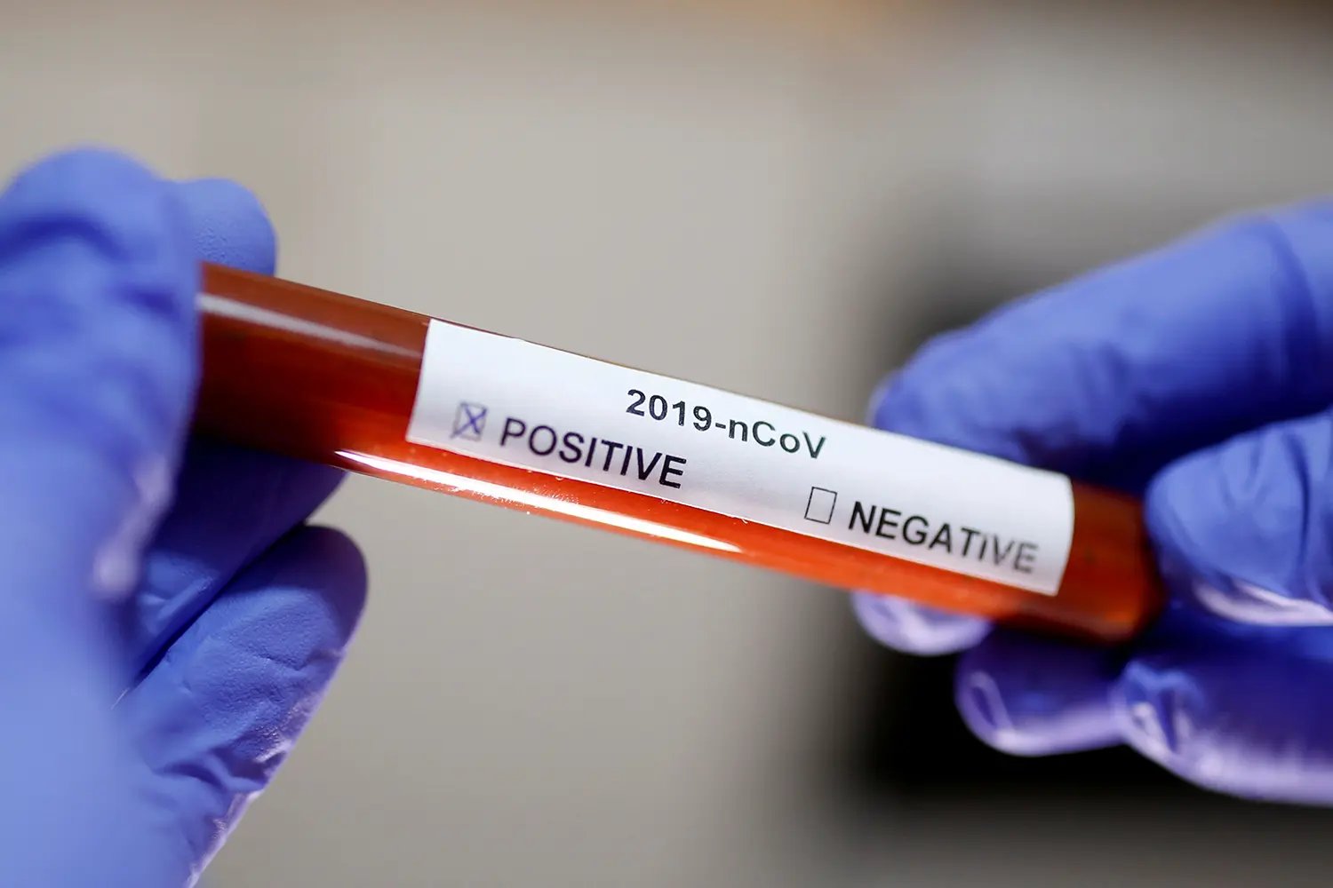 Confira o boletim epidemiol&oacute;gico desta segunda-feira (14)