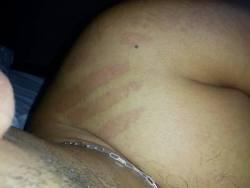 Jovem acredita que marcas no seu corpo teriam sido feitas por ET