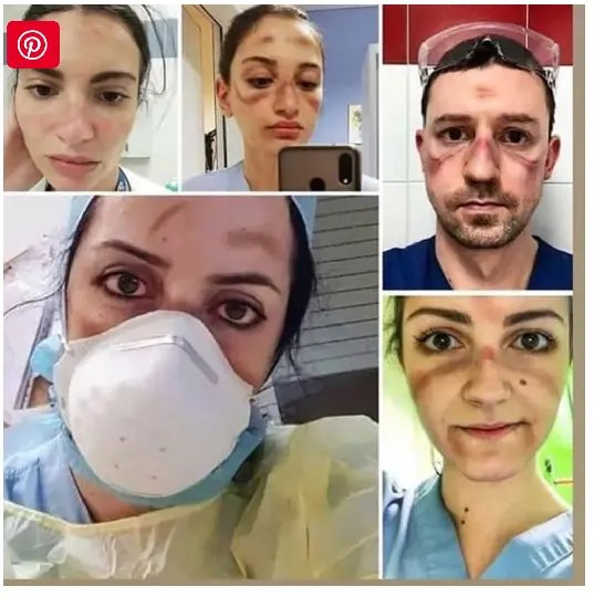Mundo: M&eacute;dicos fazem fotos para mostrar como ficam os seus rostos devido aos acess&oacute;rios de prote&ccedil;&atilde;o contra o Coronav&iacute;rus