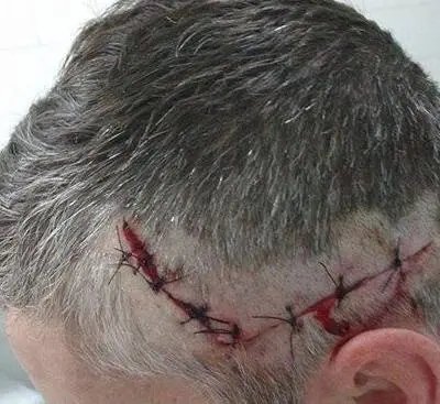 Banhista é atacado por tubarão em Balneário Camboriú