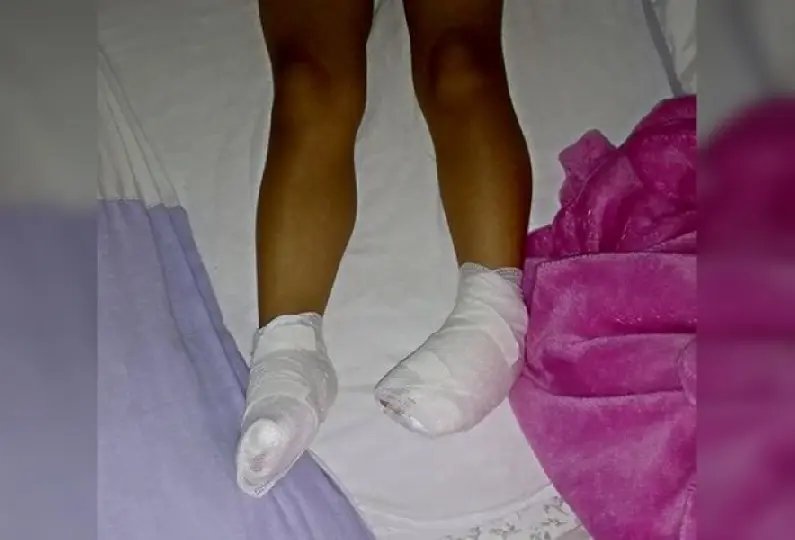 Menina é deixada descalça em creche e acaba com queimaduras