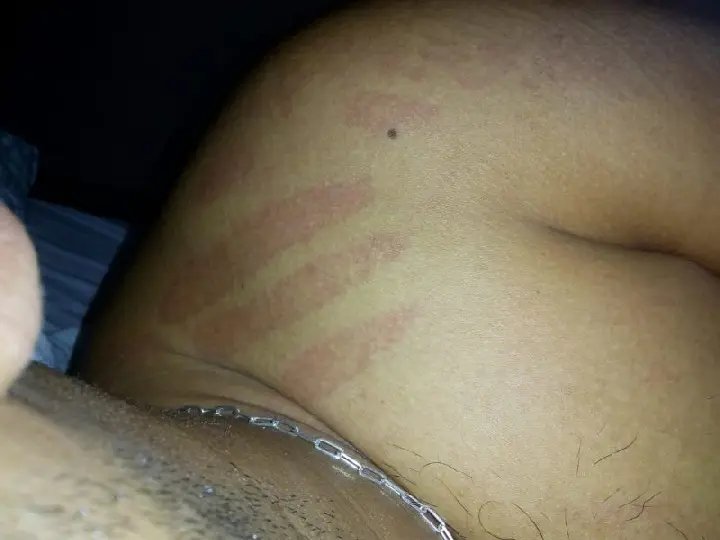 Jovem acredita que marcas no seu corpo teriam sido feitas por ET