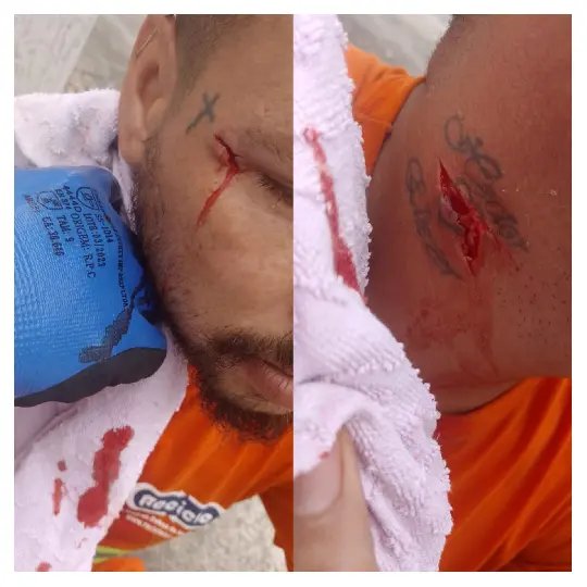 Vidros no saco de lixo quase causam tragédia a funcionário da coleta