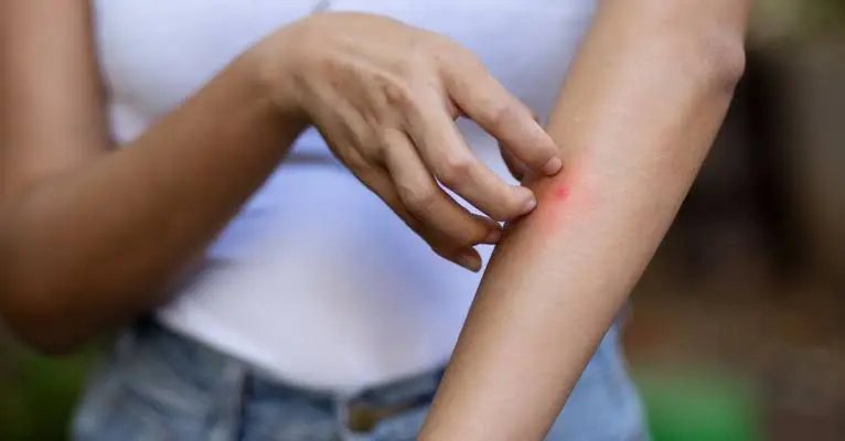 Confirmados quatro casos da febre do Oropouche 