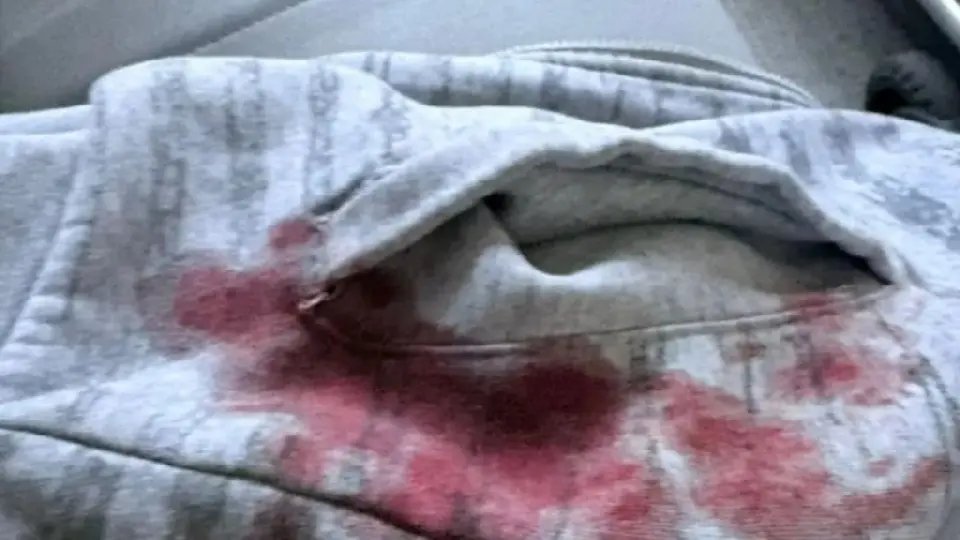 Motociclista fica ferido ao ser atingido por linha com cerol