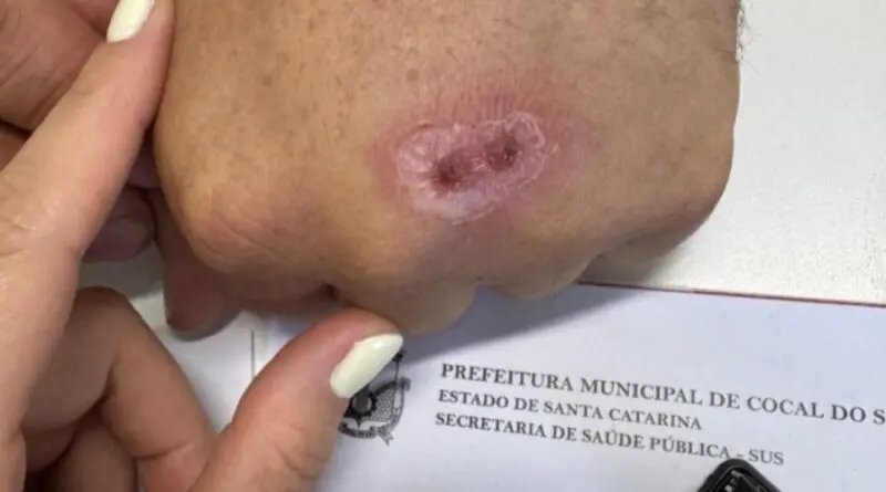 Doença transmitida por mordidas e arranhões de gatos é confirmada em cidade de SC